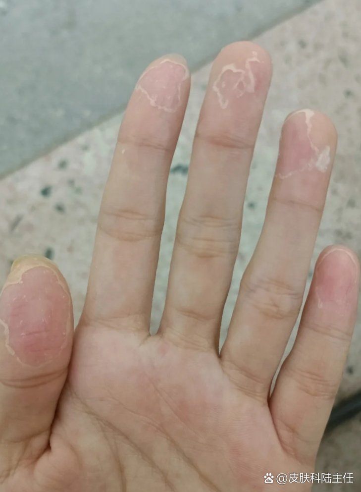紅斑病和赤皮病哪個更嚴重