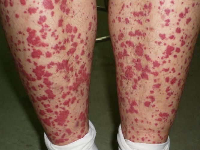 詳細(xì)閱讀:能否提供更多早期癥狀的圖片,早期癥狀的識別與分析 能否提供更多早期癥狀的圖片,早期癥狀的識別與分析