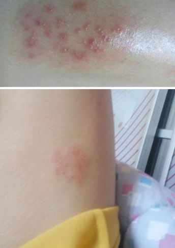 詳細(xì)閱讀:能否提供更多早期癥狀的圖片,早期癥狀的識別與分析 能否提供更多早期癥狀的圖片,早期癥狀的識別與分析