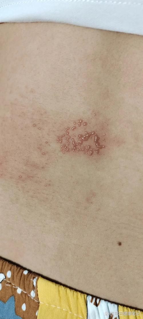 詳細(xì)閱讀:能否提供更多早期癥狀的圖片,早期癥狀的識別與分析 能否提供更多早期癥狀的圖片,早期癥狀的識別與分析