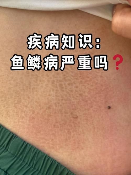 如何判斷魚是否患有爛鱗病,如何判斷魚是否患有爛鱗病、豎鱗病 龍魚百科 第2張 如何判斷魚是否患有爛鱗病,如何判斷魚是否患有爛鱗病、豎鱗病 如何判斷魚是否患有爛鱗病,如何判斷魚是否患有爛鱗病、豎鱗病 龍魚百科 第2張
