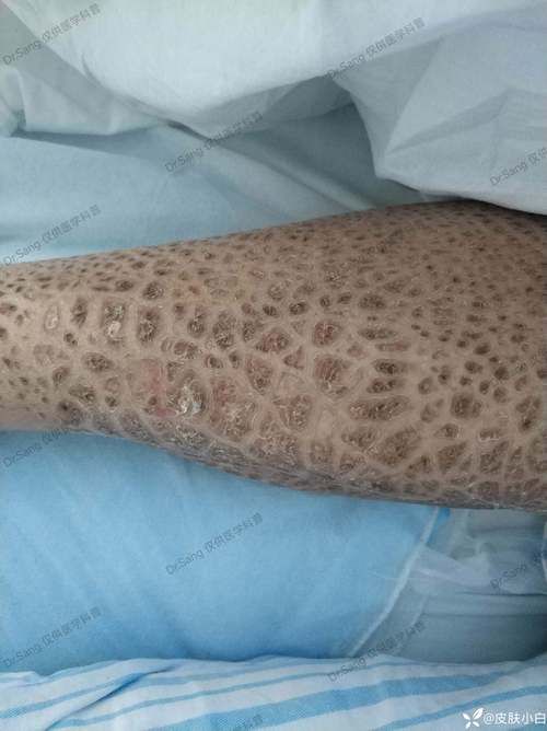 如何判斷魚是否患有爛鱗病,如何判斷魚是否患有爛鱗病、豎鱗病 龍魚百科 第3張 如何判斷魚是否患有爛鱗病,如何判斷魚是否患有爛鱗病、豎鱗病 如何判斷魚是否患有爛鱗病,如何判斷魚是否患有爛鱗病、豎鱗病 龍魚百科 第3張