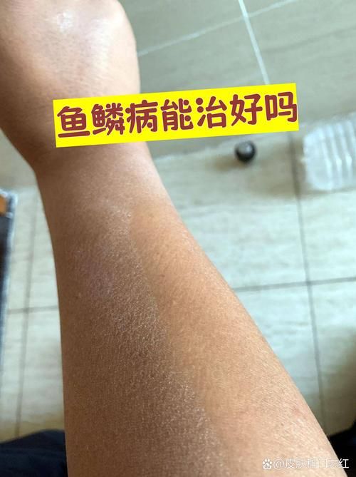 如何判斷魚是否患有爛鱗病,如何判斷魚是否患有爛鱗病、豎鱗病 龍魚百科 第5張 如何判斷魚是否患有爛鱗病,如何判斷魚是否患有爛鱗病、豎鱗病 如何判斷魚是否患有爛鱗病,如何判斷魚是否患有爛鱗病、豎鱗病 龍魚百科 第5張