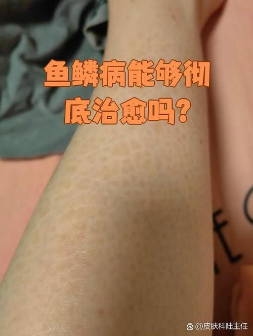 如何判斷魚是否患有爛鱗病,如何判斷魚是否患有爛鱗病、豎鱗病 龍魚百科 第4張 如何判斷魚是否患有爛鱗病,如何判斷魚是否患有爛鱗病、豎鱗病 如何判斷魚是否患有爛鱗病,如何判斷魚是否患有爛鱗病、豎鱗病 龍魚百科 第4張